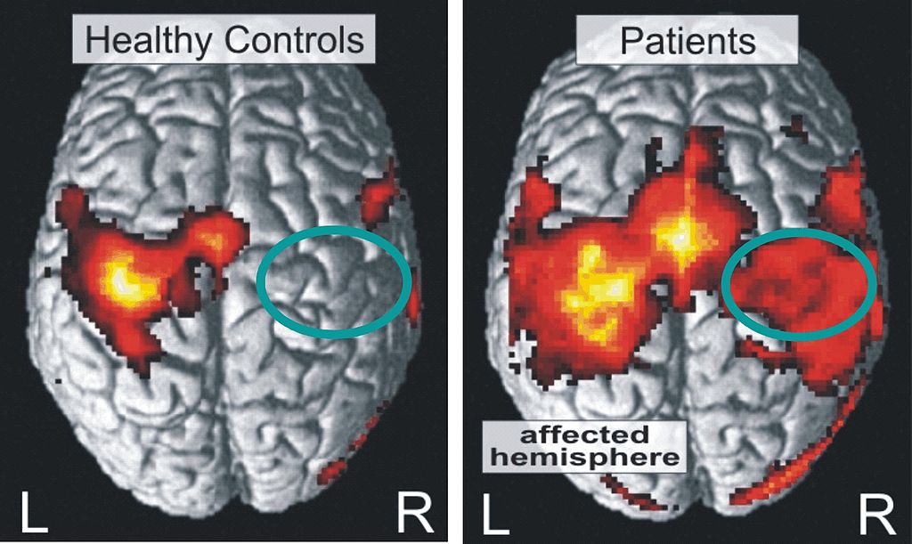 Accidente Cerebro Vascular